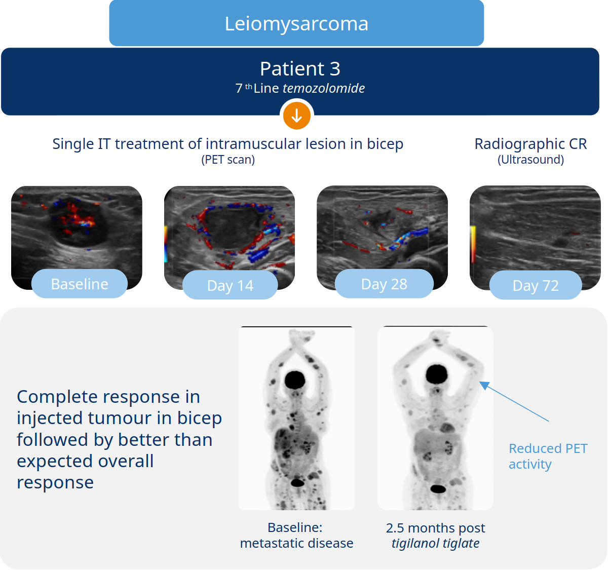 Leiomysarcoma chart
