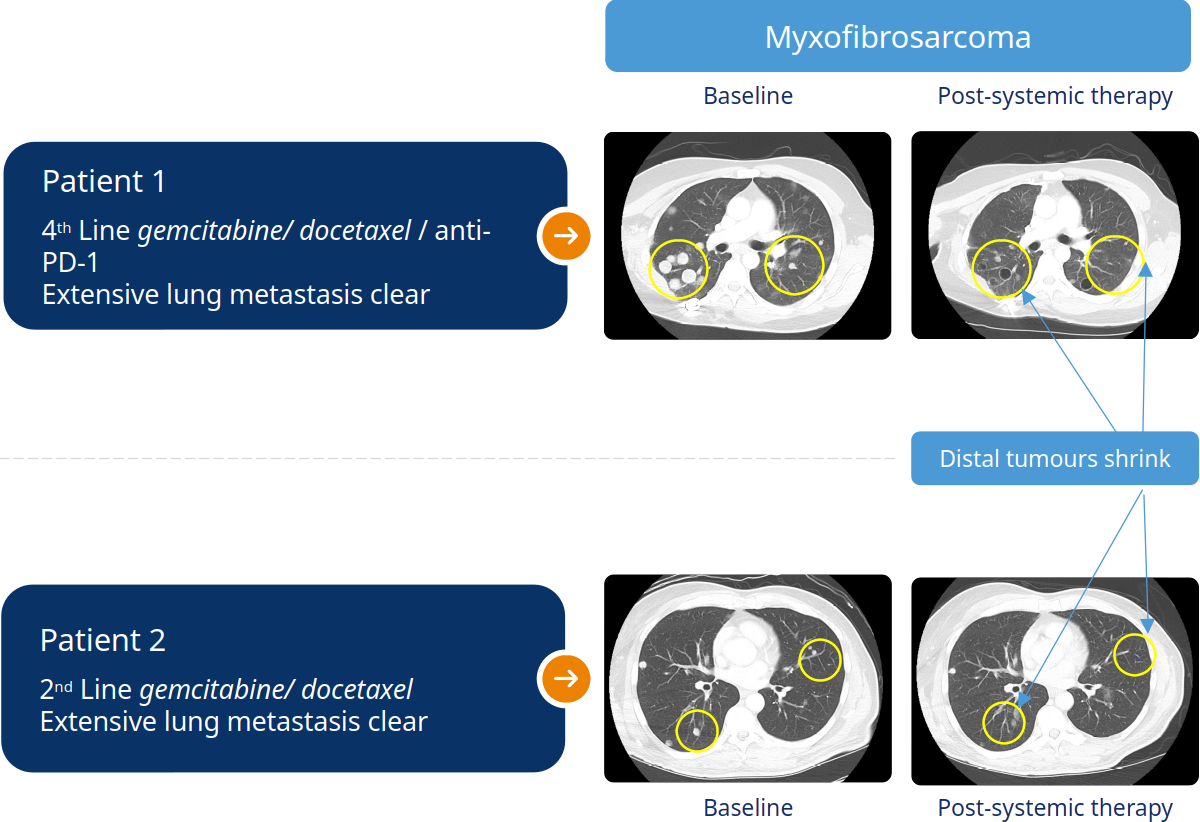 Myxofibrosarcoma chart