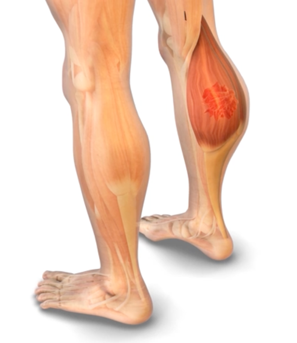 STS in calf muscle - animation